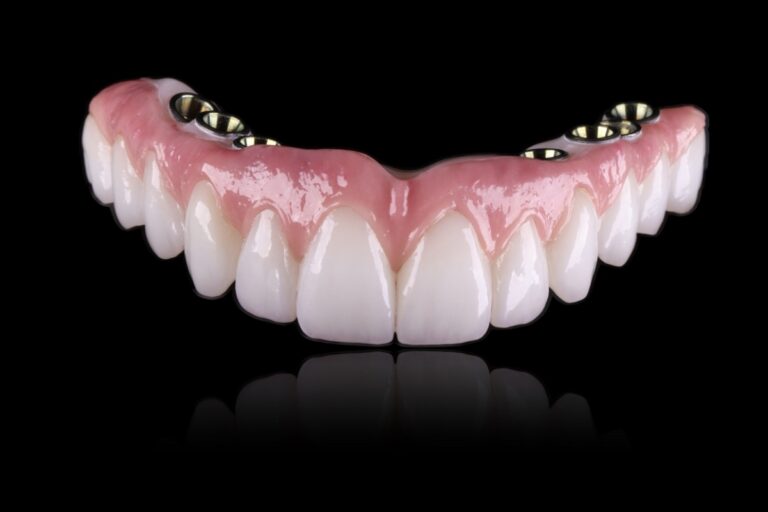 Les prothèses dentaires sur implants